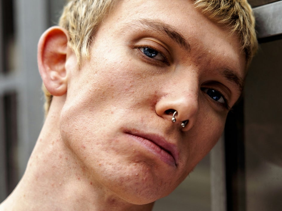 blemish-fix-perfect-skin-before